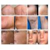 Buy cheap Professional Lazer Beauty Device 808 755 1064 Painless Diode Laser Hair Removal Machine from wholesalers