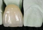 Smooth Surface PFM Metal-Ceramic Crown Corrosion Resistant