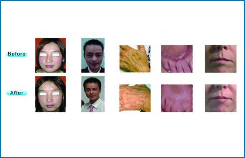 Vertical CO2 Fractional Laser Machine , USA Emitter Vaginal Rejuvenation Machine