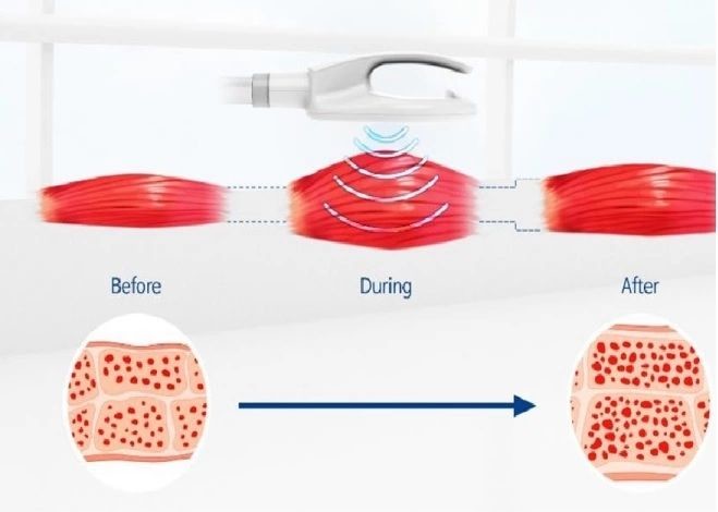 Electromagnetic Radio Frequency Fat Reduction Machine Cellulite Removal
