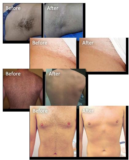 Buy cheap Most Professional 2016 Best Diode Laser Hair Removal Machine for Sale!! from wholesalers