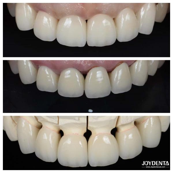 Buy cheap Excellent Biocompatibility Dental Porcelain Veneers No Need For Preparation Process from wholesalers