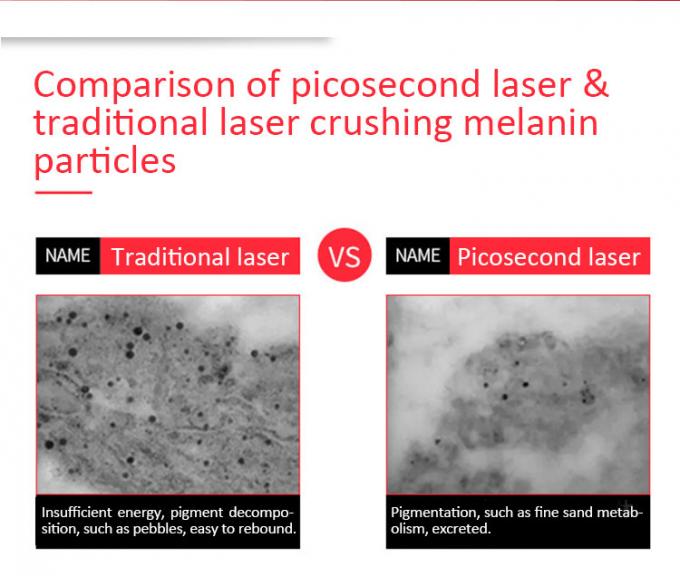 900ps Powerful Picosecond Laser For Tattoo Removal High Homogeneous Spot Mode 1