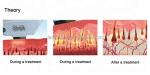 480nm 530nm SHR Diode Laser Hair Removal IPL Ice Cold Beauty Equipment