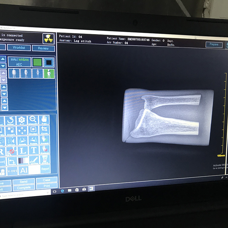Good Price Digital Mobile X-ray Machine Digital X Ray Portable Machine