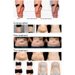 Purple Airbags Pressotherapy Lymphatic Drainage Machine 400w For Slimming