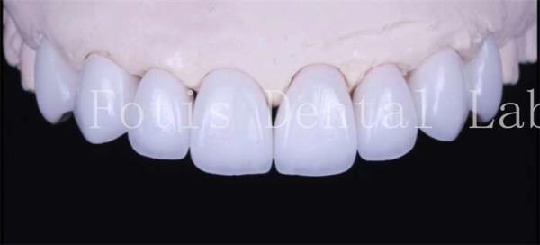 Buy cheap Adhesive Bonding Cement Natural White Veneers With High Translucency from wholesalers