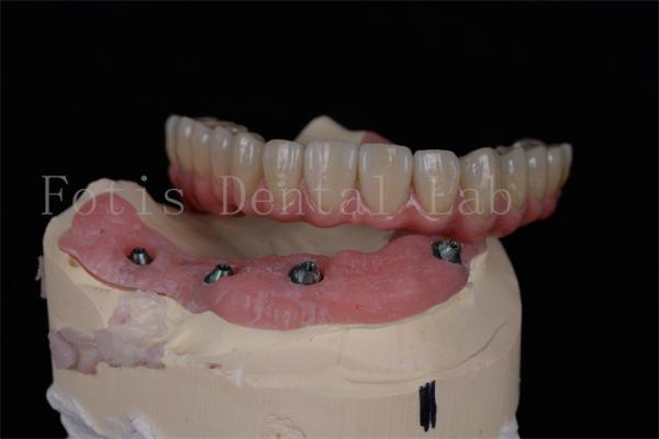 Buy cheap Customizable All On 4 All On 6 Dental Implants For Complete Oral Rehabilitation from wholesalers