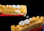 OEM Precision Fit Ceramic Inlays Onlays for Durable and Natural-Looking Dental