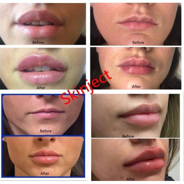 Injectable Hyaluronic Acid Facial Fillers Juvederm Ultra 3 Ultra 4 Voluma