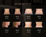 Liposlim Ultrasound Vacuum Ultrasonic 80K RF Wrinkle Removal and Body Slimming