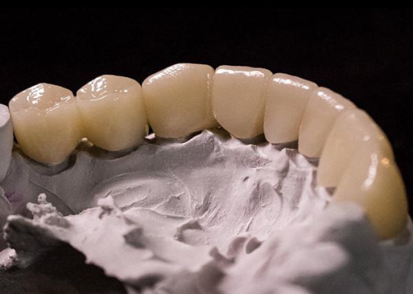 Porcelain Fused to Metal Crowns - Advanced Technology for Long Lasting Smile