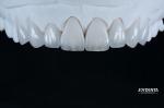 Natural Looking Emax Porcelain Veneer Comfortable Fit Ultra Thin Emax Veneers