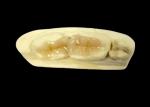 Biocompatible Ceramic Inlays Onlays Seamless Dental Restoration with Stain