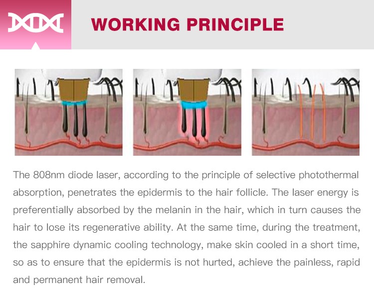 DPL most intelligent and professional portable permanent Hair Removal 808nm laser diode beauty equipment
