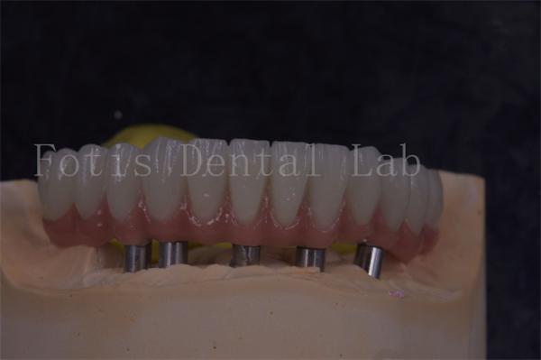 Buy cheap Customizable Dental Implant Crowns For Natural Looking And Comfortable Restorations from wholesalers