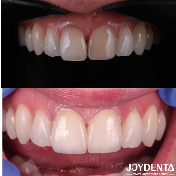 Smooth Surface Dental Veneers For Crooked Teeth , Custom Cosmetic Porcelain