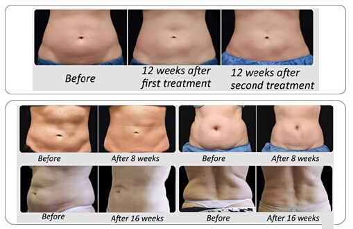 Hottest!! Cryolipolysis Fat Freezing Slimming + Laser Weight Loss Machine for body shaping