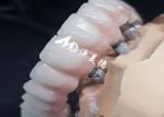 Exclusive High Performance Dental Implant Crown Bridge Various Sizes Available
