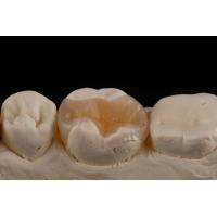 Buy cheap E Max Material Inlay And Onlay In Dentistry Aesthetic Restoration Long Lasting product