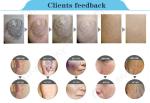 Professional q switched nd yag laser tattoo removal machine with CE approved