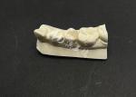 Hypoallergenic Stain-Resistant Emax Ceramic Inlay for Accurate Repair of Damaged