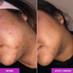 Alcohol Free Skin Molecules Discoloration Correcting Serum Tranexamic Acid