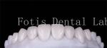 Polishing Finishing Cosmetic Teeth Veneer Covers For Beautiful Smile